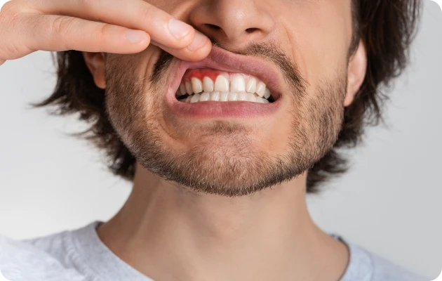 maladies-parodontales