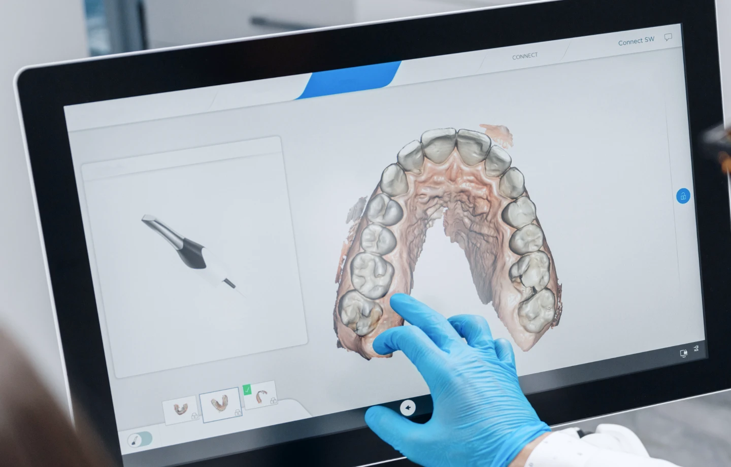 L’empreinte optique numérique au cabinet du Dr Loïc Feuerstoss, dentiste à Marseille